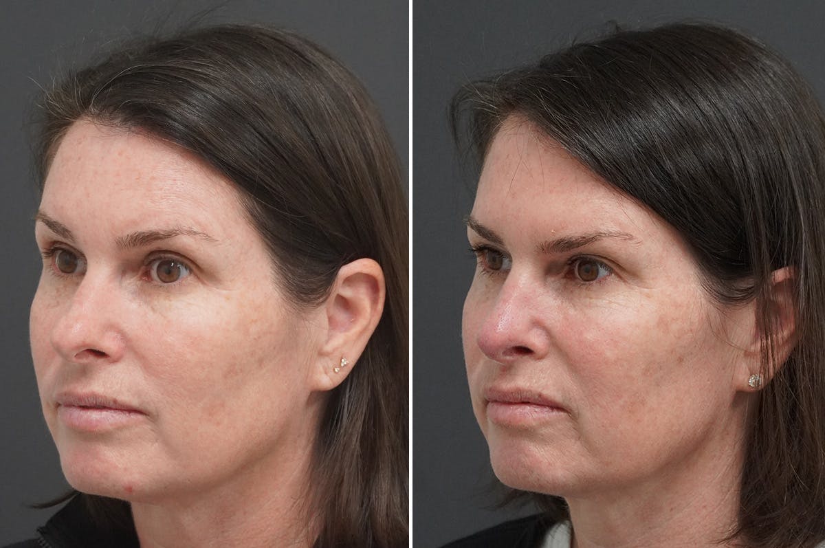 Rhinoplasty Before & After Gallery - Patient 243362 - Image 4