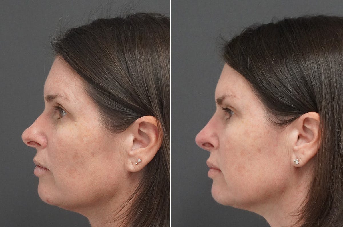 Rhinoplasty Before & After Gallery - Patient 243362 - Image 5