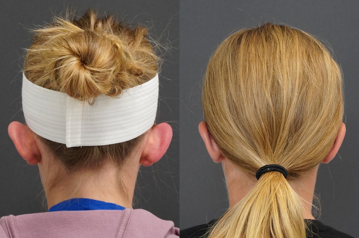 Otoplasty Before & After Gallery - Patient 357492 - Image 2