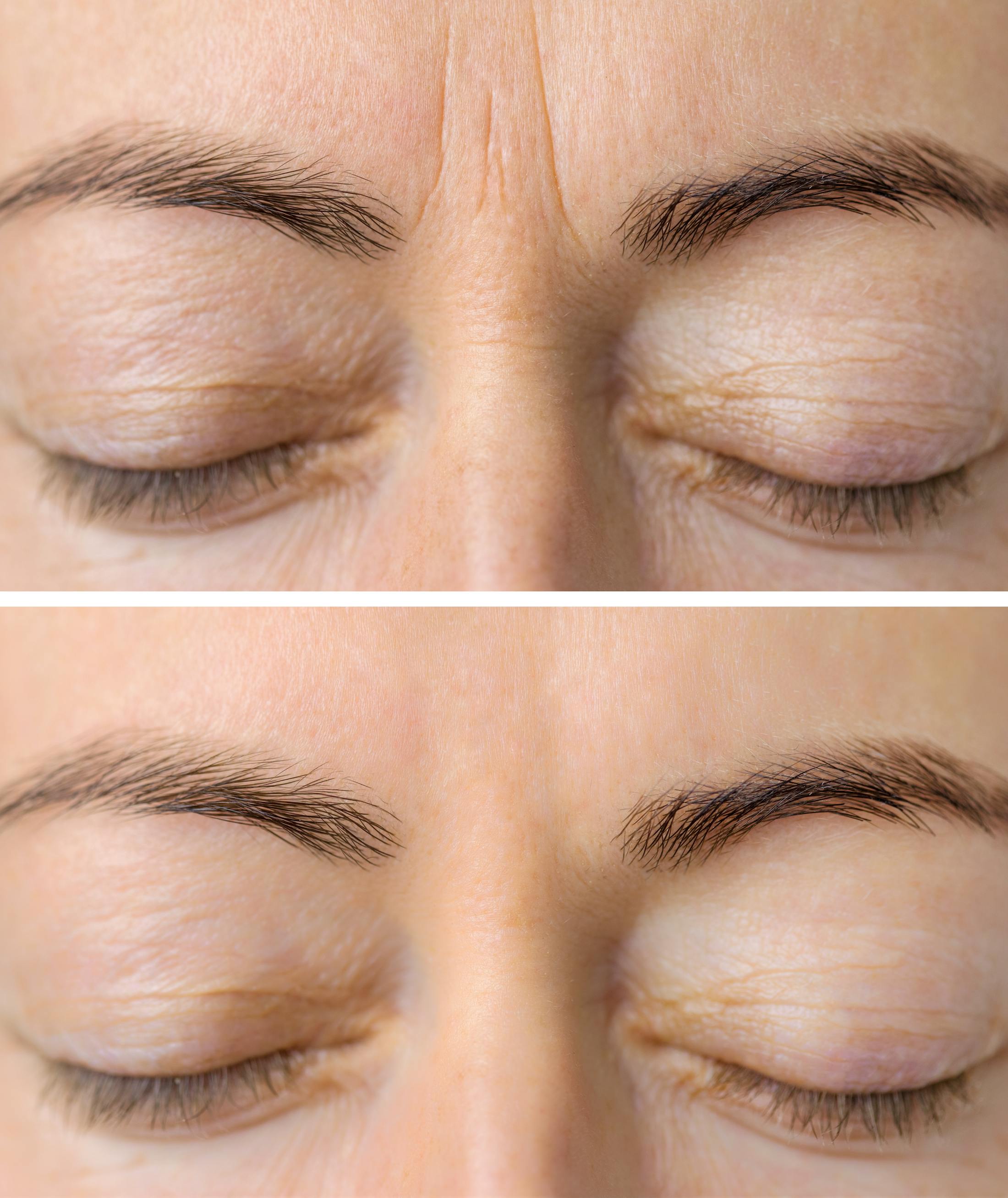 Before and After shot of Botox