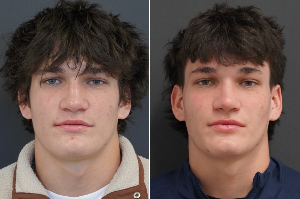Rhinoplasty Before & After Gallery - Patient 334085 - Image 3
