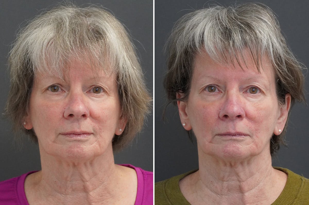 Rhinoplasty Before & After Gallery - Patient 360910 - Image 5