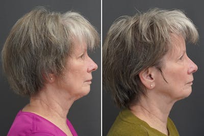 Rhinoplasty Before & After Gallery - Patient 360910 - Image 1