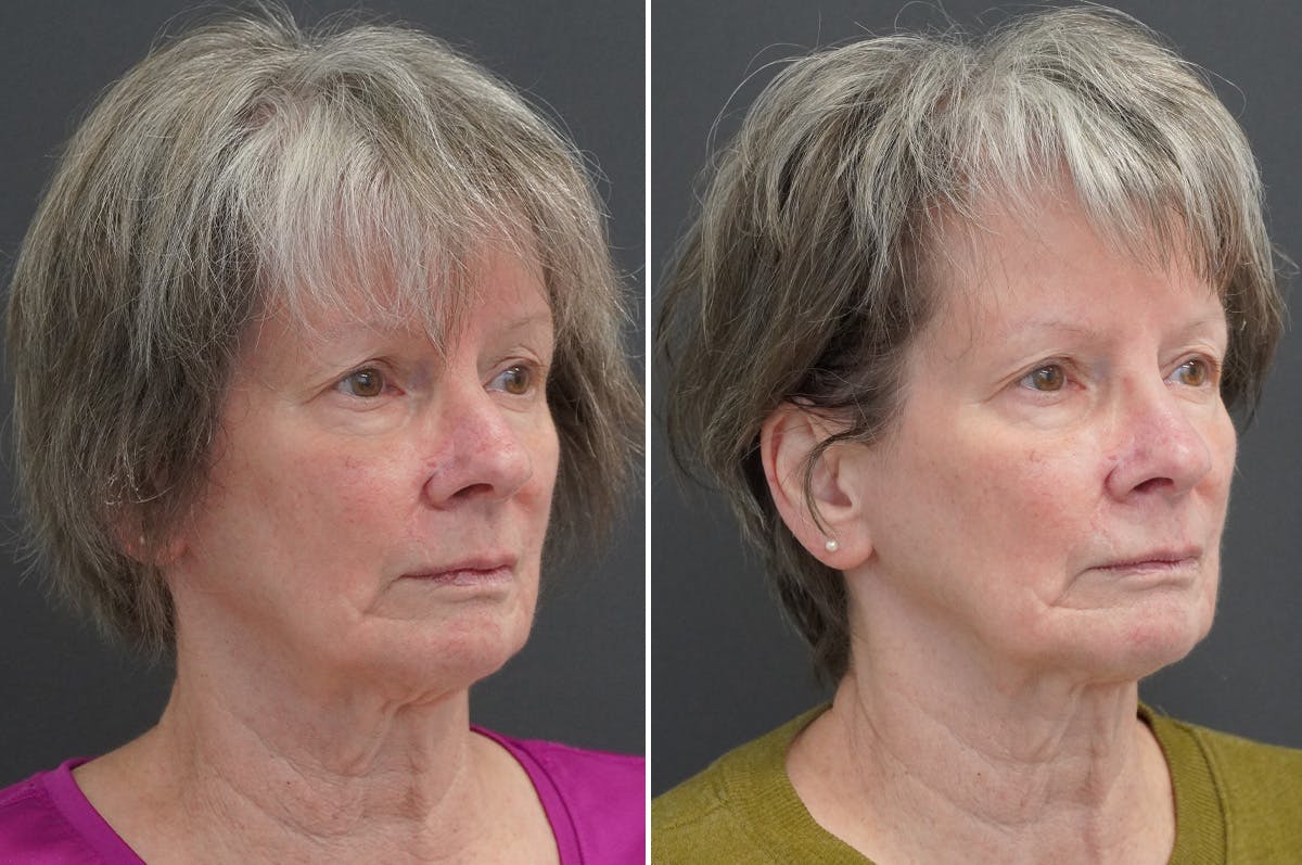 Rhinoplasty Before & After Gallery - Patient 360910 - Image 2