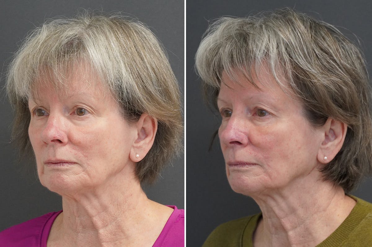 Rhinoplasty Before & After Gallery - Patient 360910 - Image 3