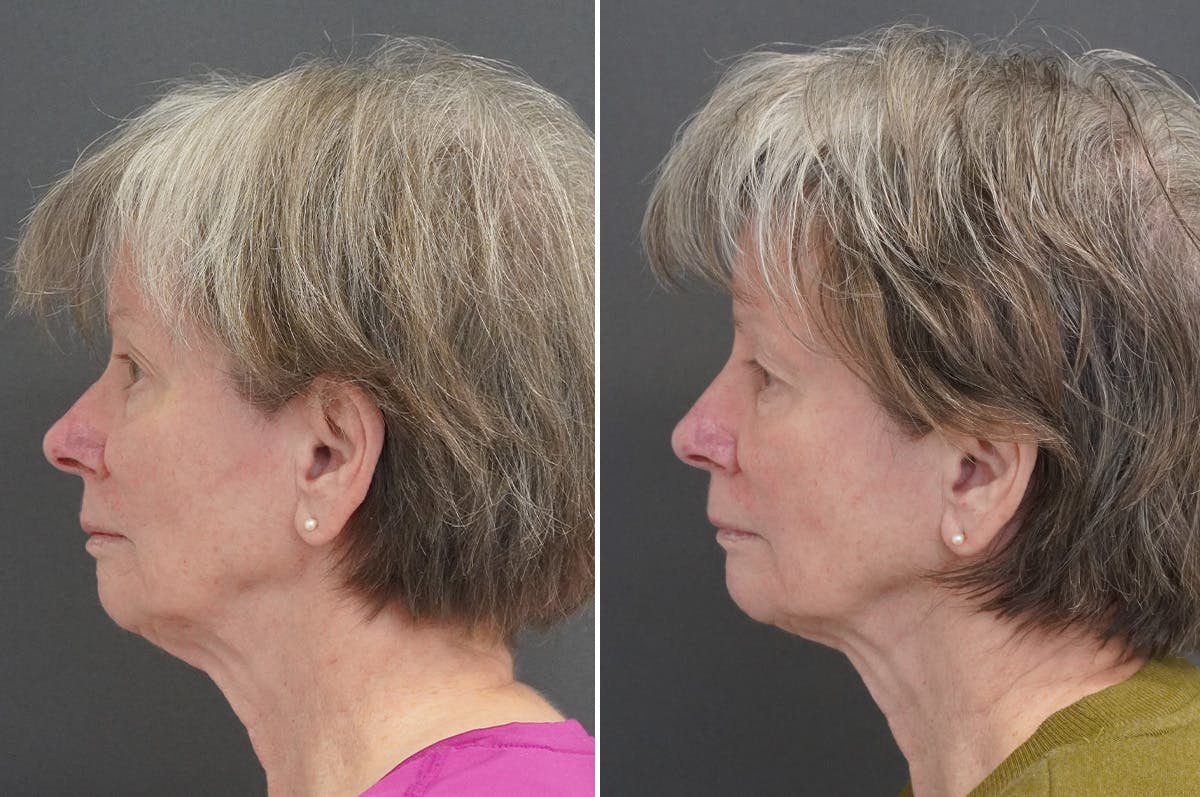 Rhinoplasty Before & After Gallery - Patient 360910 - Image 4