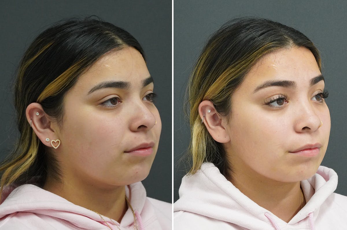 Rhinoplasty Before & After Gallery - Patient 349917 - Image 2