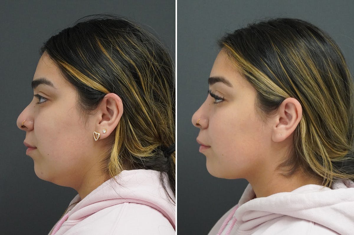 Rhinoplasty Before & After Gallery - Patient 349917 - Image 4