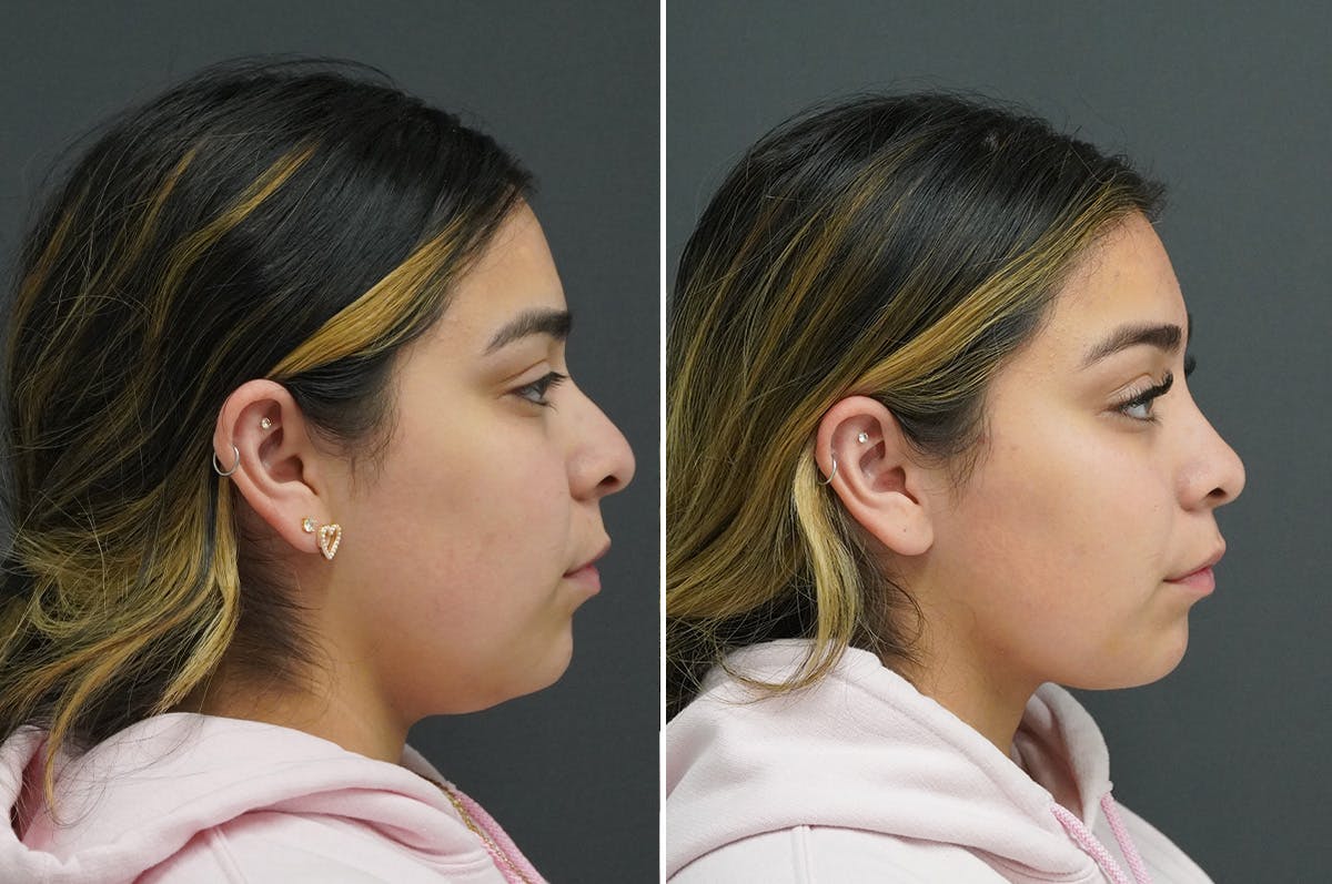 Rhinoplasty Before & After Gallery - Patient 349917 - Image 1