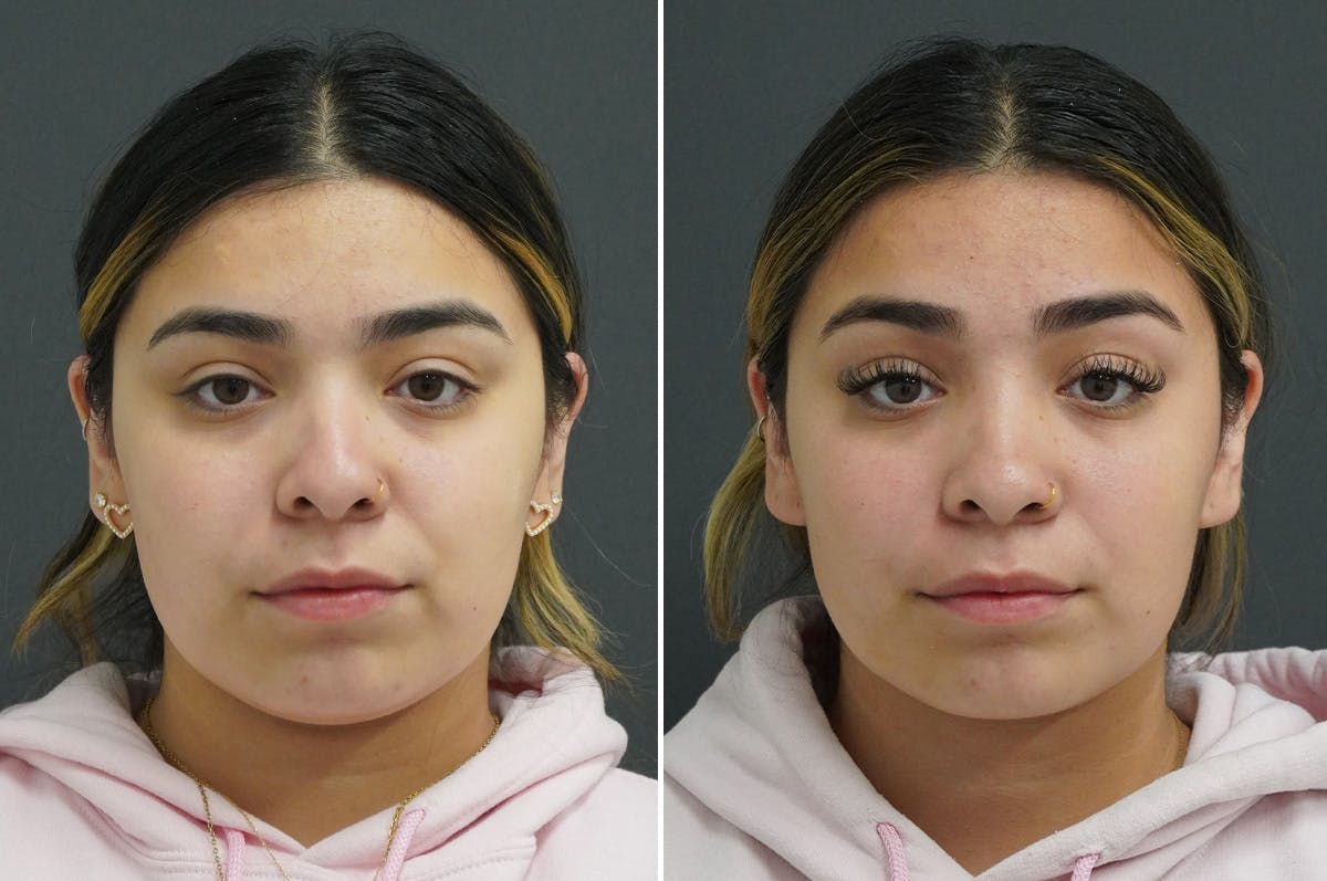 Rhinoplasty Before & After Gallery - Patient 349917 - Image 5