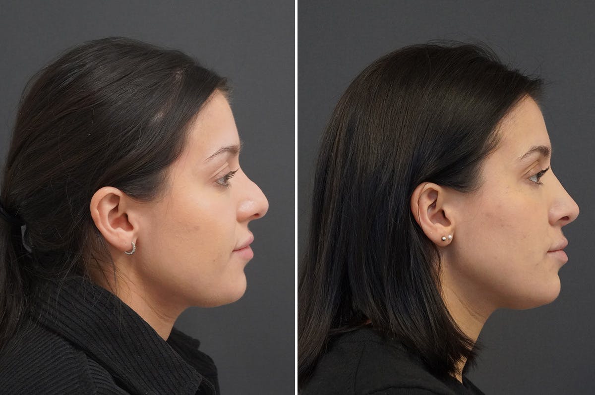 Rhinoplasty Before & After Gallery - Patient 168184 - Image 1