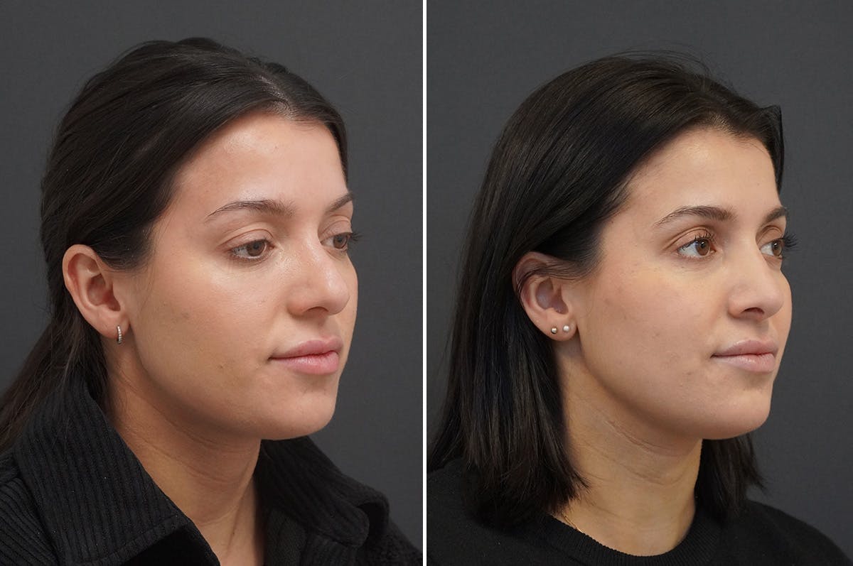 Rhinoplasty Before & After Gallery - Patient 168184 - Image 2