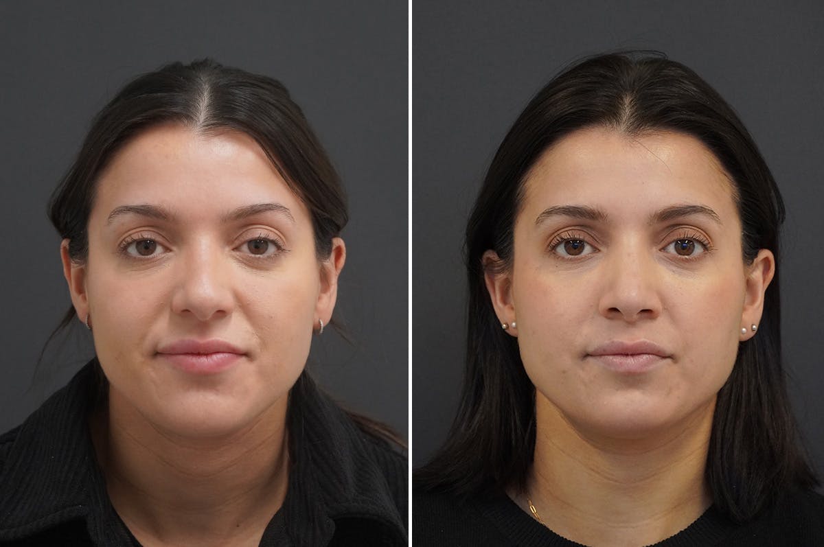 Rhinoplasty Before & After Gallery - Patient 168184 - Image 5