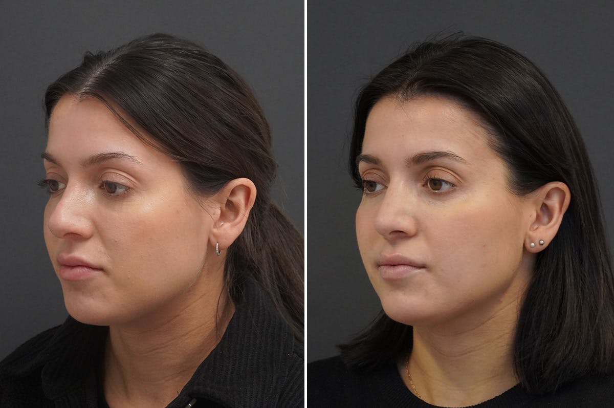 Rhinoplasty Before & After Gallery - Patient 168184 - Image 3