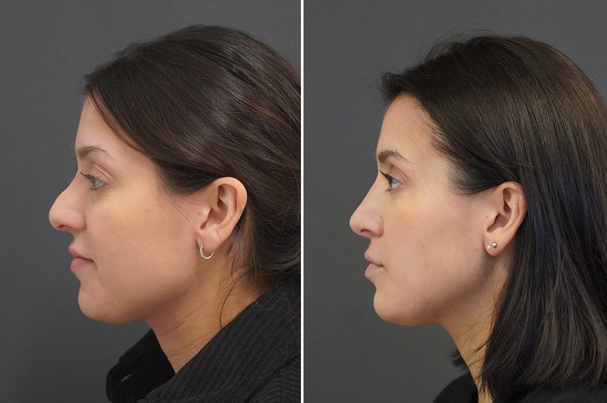 Rhinoplasty Before & After Gallery - Patient 168184 - Image 4