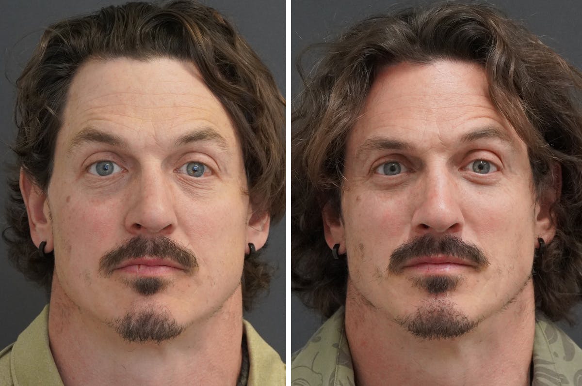 Rhinoplasty Before & After Gallery - Patient 228046 - Image 1