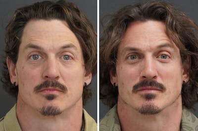 Rhinoplasty Before & After Gallery - Patient 228046 - Image 1