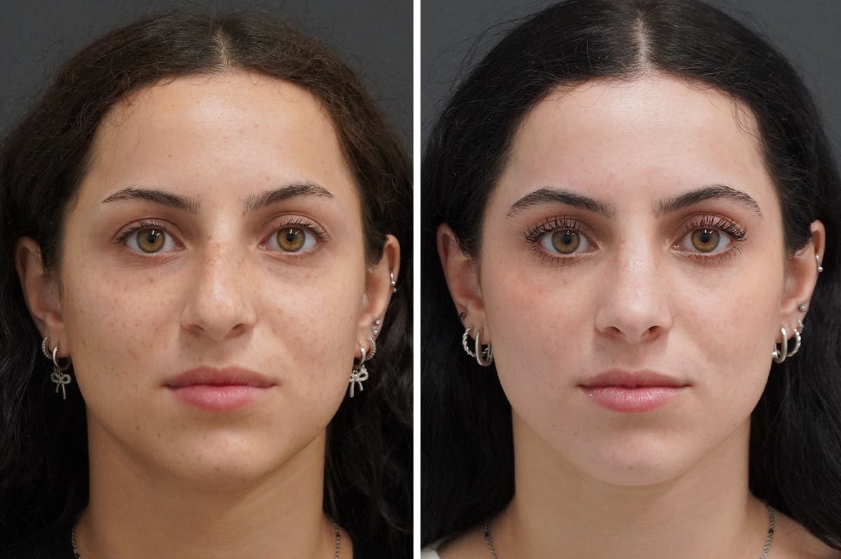 Rhinoplasty Before & After Gallery - Patient 251427 - Image 3