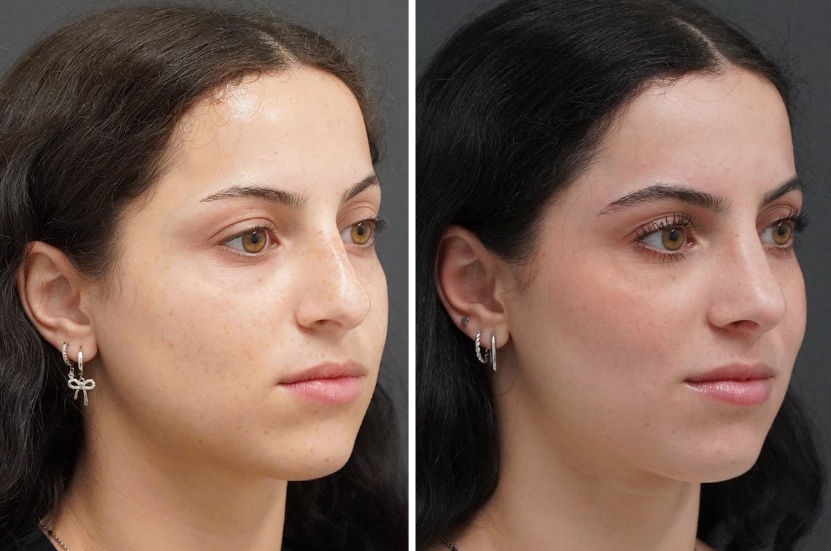 Rhinoplasty Before & After Gallery - Patient 251427 - Image 2