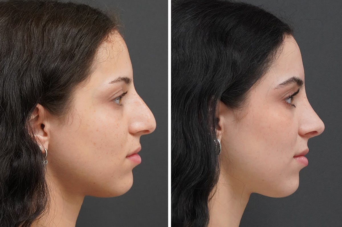 Rhinoplasty Before & After Gallery - Patient 251427 - Image 1