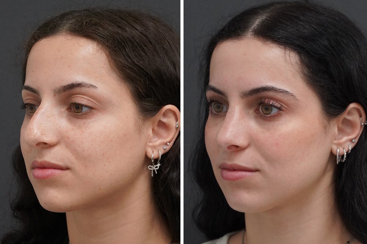 Rhinoplasty Before & After Gallery - Patient 251427 - Image 4