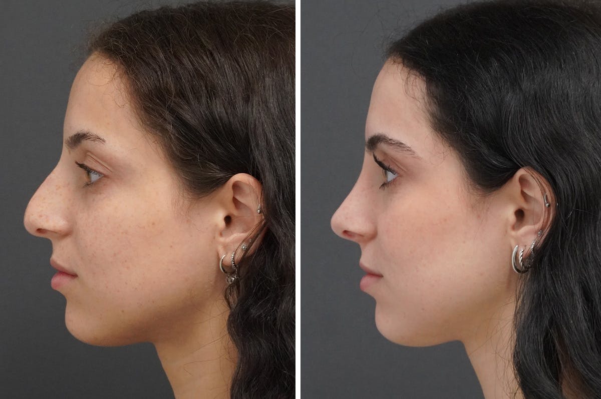 Rhinoplasty Before & After Gallery - Patient 251427 - Image 5
