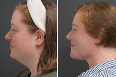 Neck Lift Before & After Gallery - Patient 417614 - Image 1