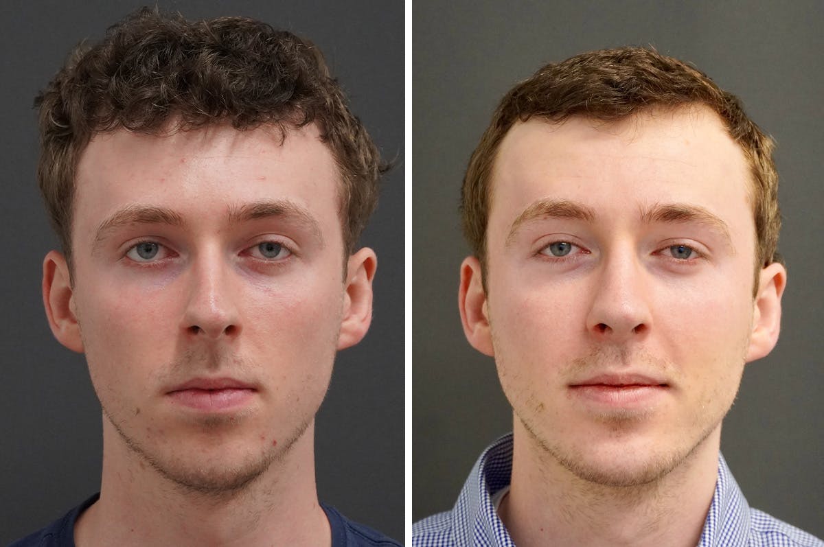 Chin Implant Before & After Gallery - Patient 174050 - Image 3