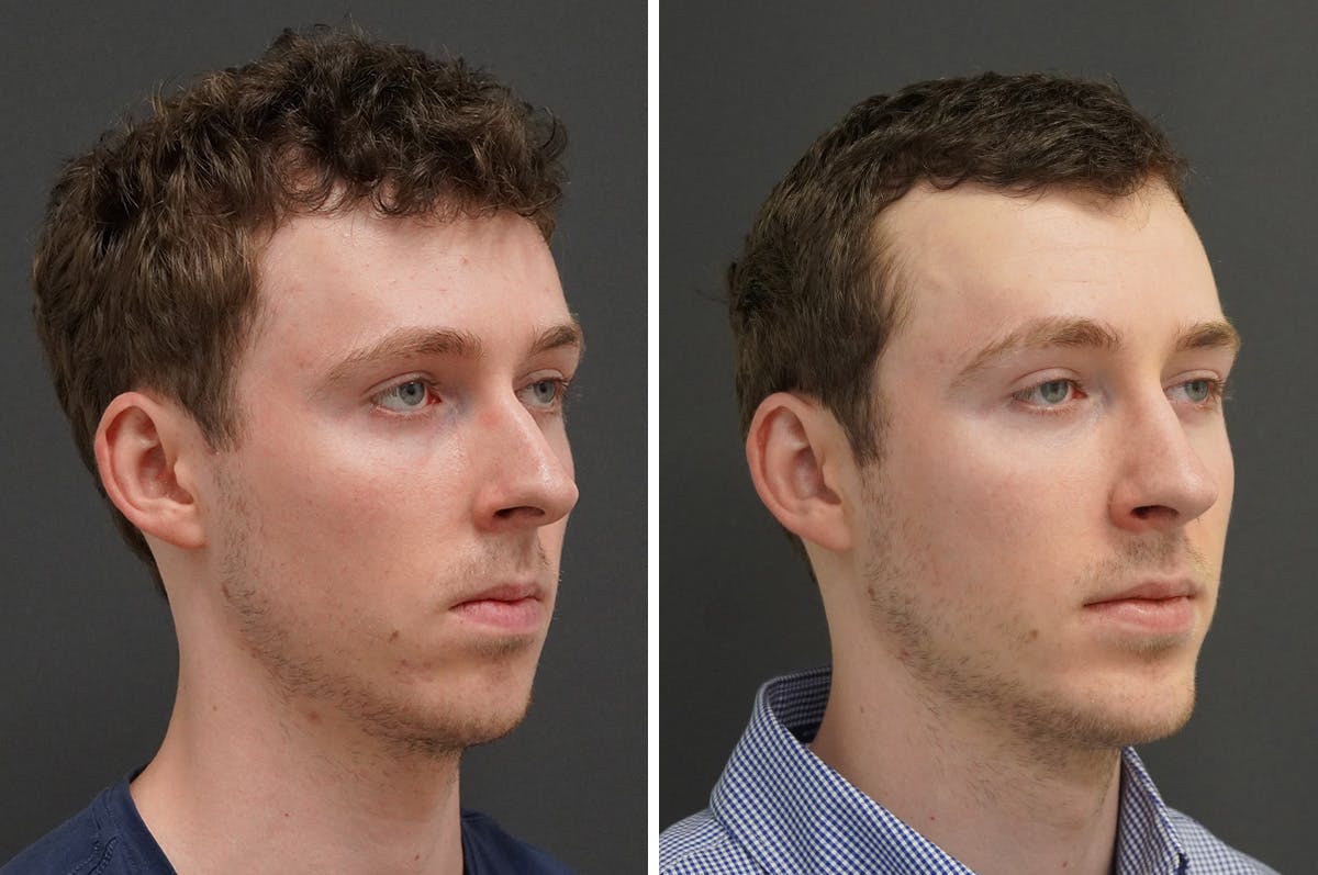 Chin Implant Before & After Gallery - Patient 174050 - Image 2