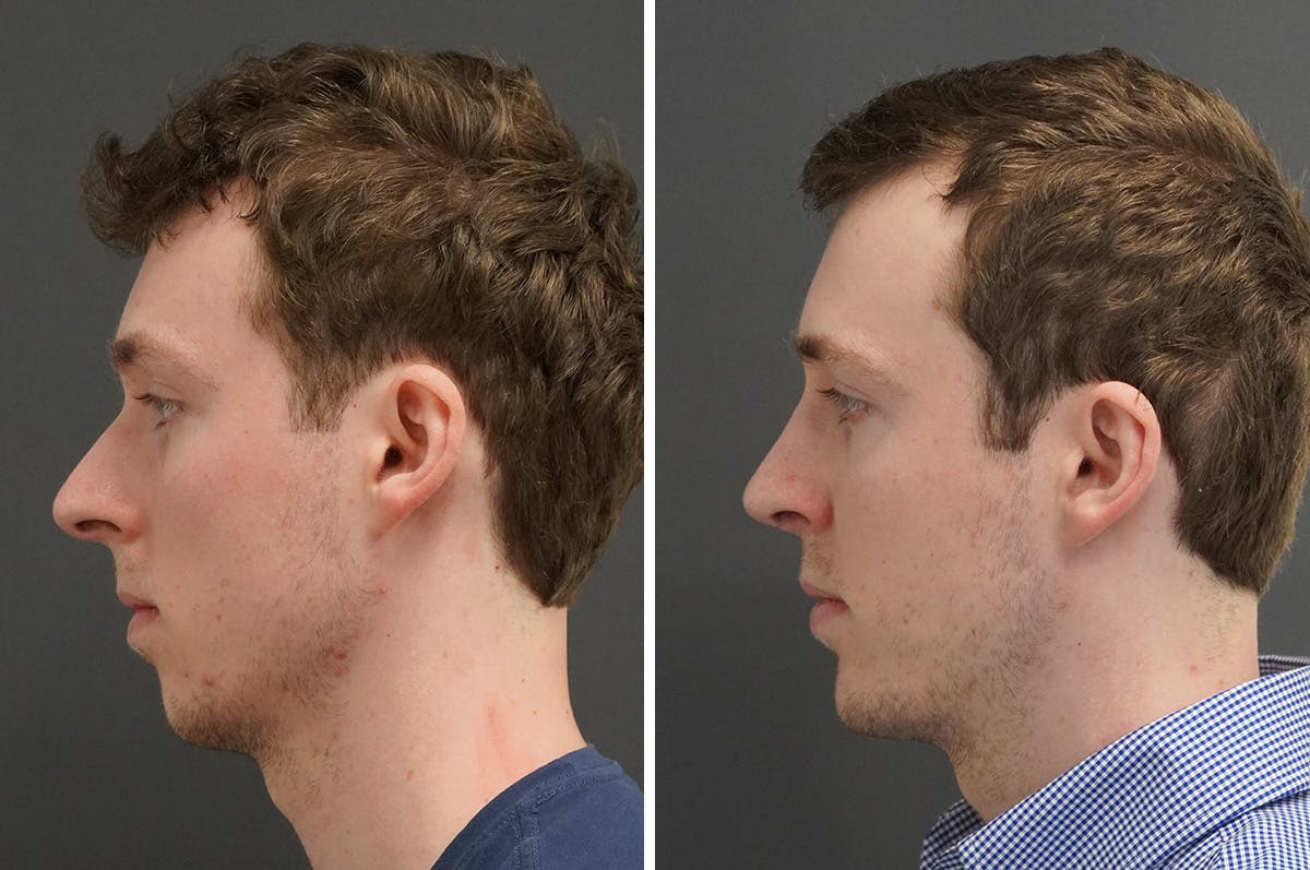 Chin Implant Before & After Gallery - Patient 174050 - Image 4