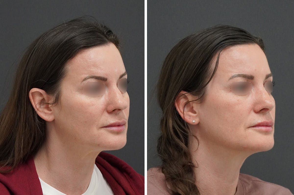 Rhinoplasty Before & After Gallery - Patient 946804 - Image 2
