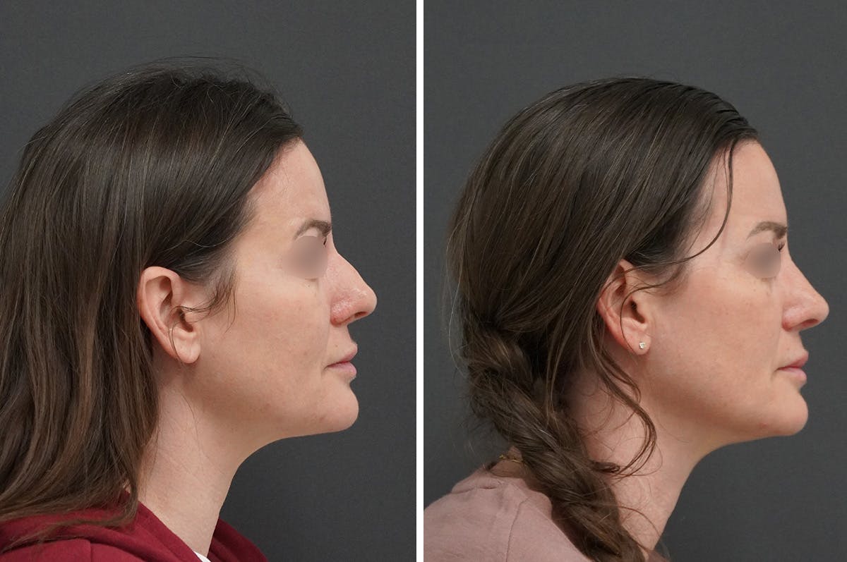 Rhinoplasty Before & After Gallery - Patient 946804 - Image 1