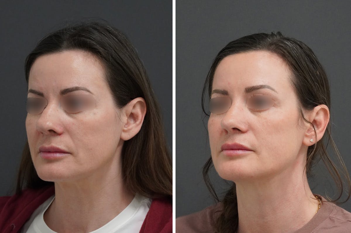 Rhinoplasty Before & After Gallery - Patient 946804 - Image 4