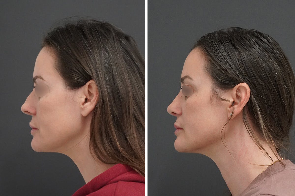 Rhinoplasty Before & After Gallery - Patient 946804 - Image 5