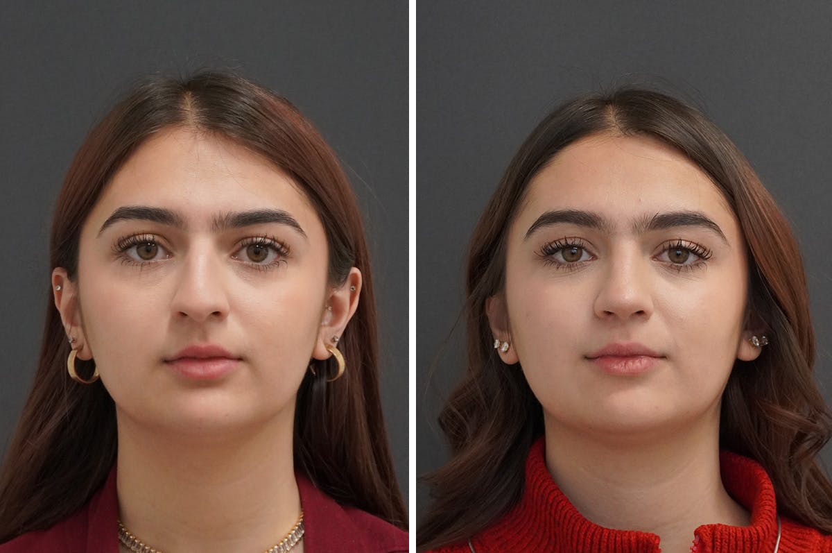 Rhinoplasty Before & After Gallery - Patient 871524 - Image 3