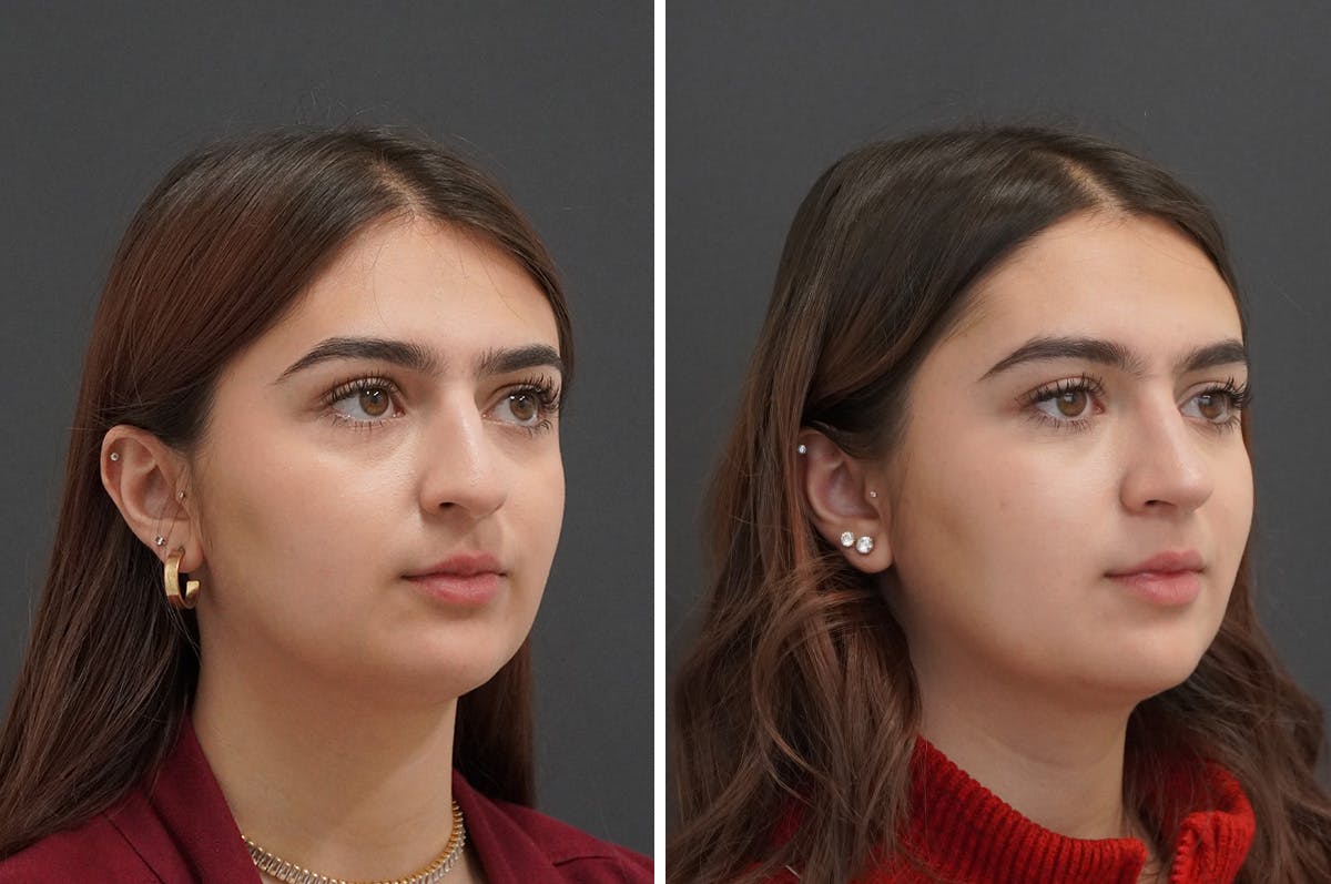 Rhinoplasty Before & After Gallery - Patient 871524 - Image 2