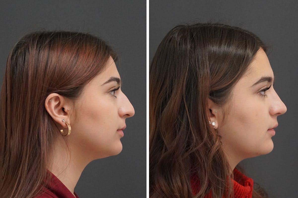 Rhinoplasty Before & After Gallery - Patient 871524 - Image 1