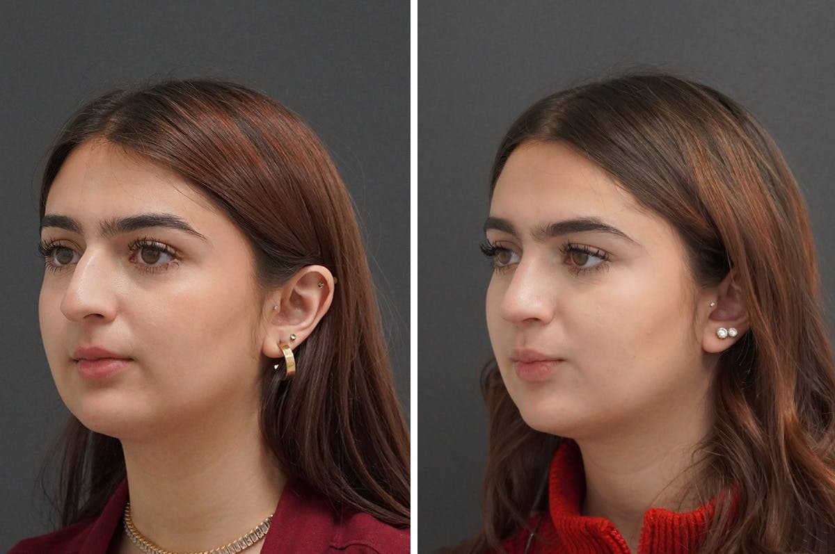 Rhinoplasty Before & After Gallery - Patient 871524 - Image 5