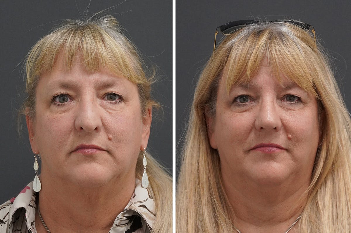 Rhinoplasty Before & After Gallery - Patient 650616 - Image 1