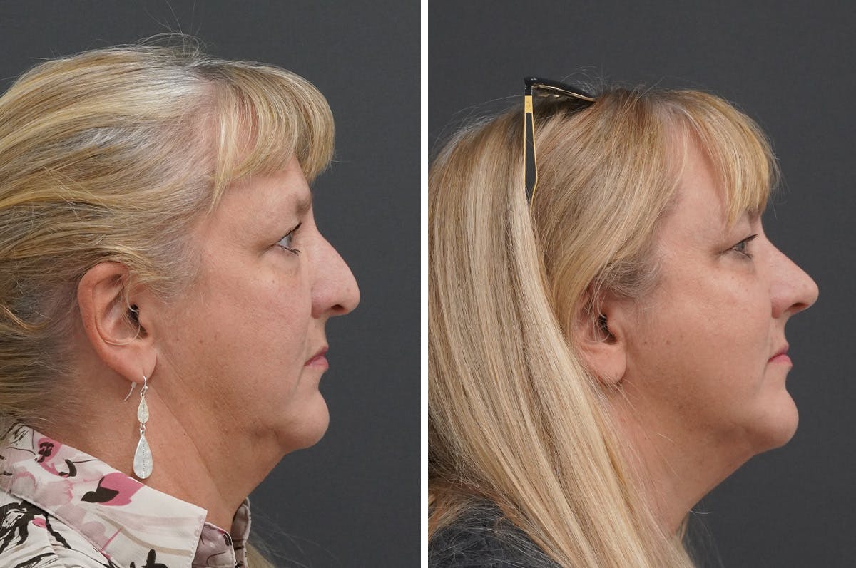 Rhinoplasty Before & After Gallery - Patient 650616 - Image 2