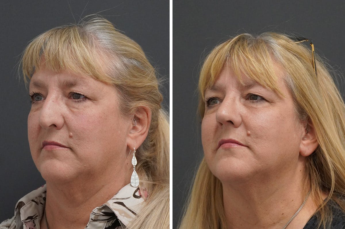 Rhinoplasty Before & After Gallery - Patient 650616 - Image 5