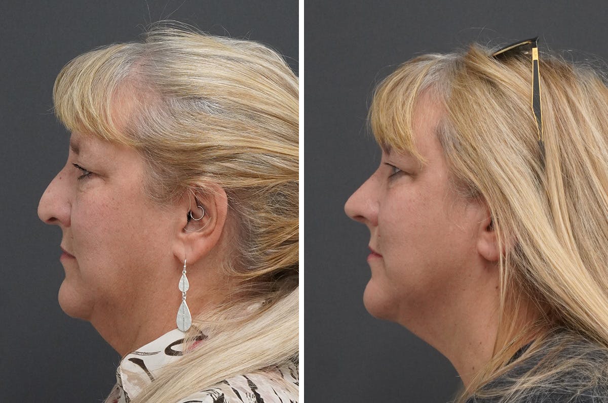 Rhinoplasty Before & After Gallery - Patient 650616 - Image 4