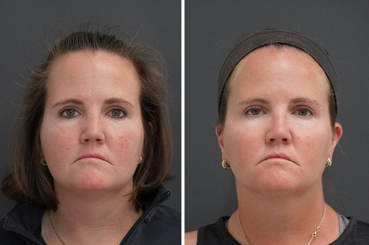 Rhinoplasty Before & After Gallery - Patient 116463 - Image 1