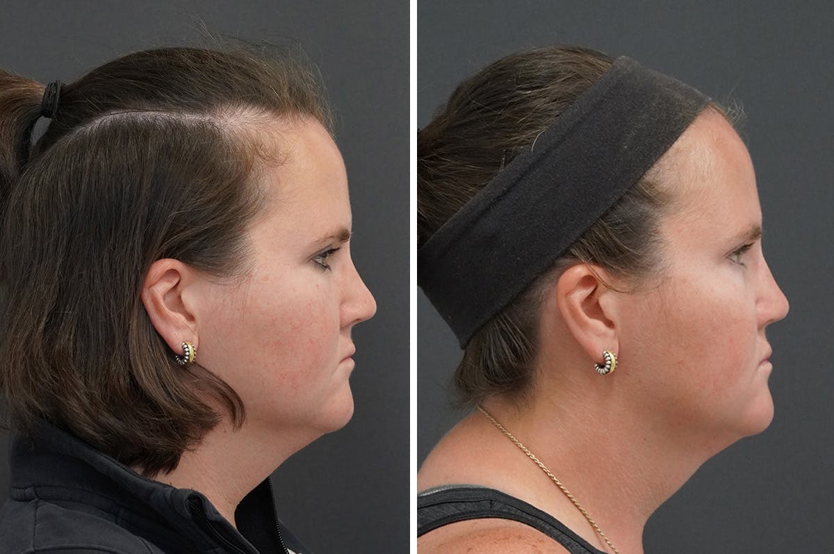 Rhinoplasty Before & After Gallery - Patient 116463 - Image 2