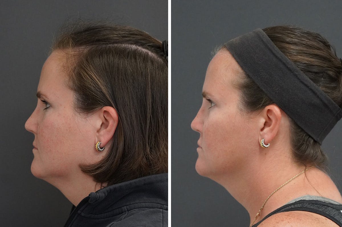 Rhinoplasty Before & After Gallery - Patient 116463 - Image 3