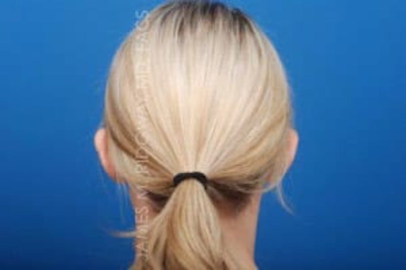 Ear Surgery (Otoplasty) Before & After Gallery - Patient 149049749 - Image 11