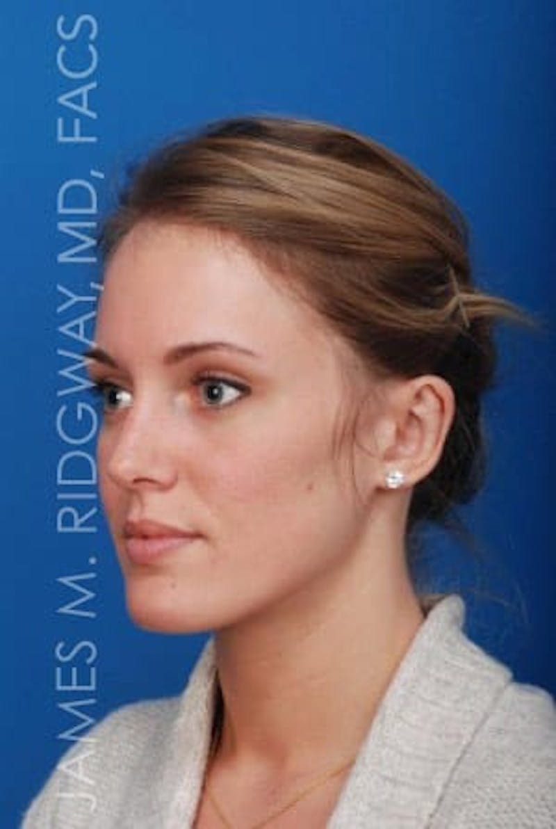 Ear Surgery (Otoplasty) Before & After Gallery - Patient 149049749 - Image 2