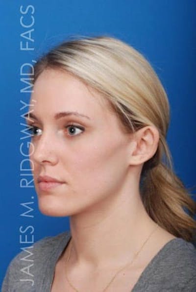 Ear Surgery (Otoplasty) Before & After Gallery - Patient 149049749 - Image 1