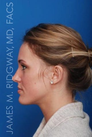 Ear Surgery (Otoplasty) Before & After Gallery - Patient 149049749 - Image 4