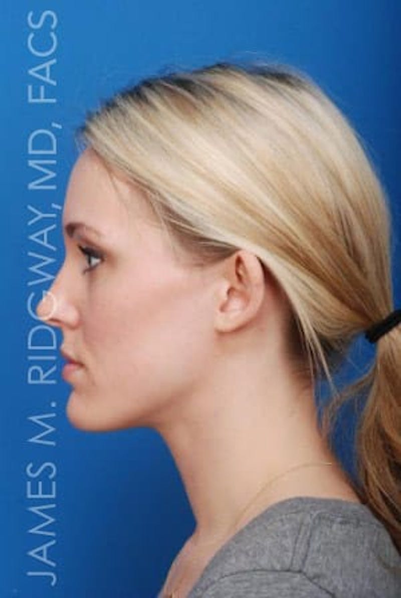 Ear Surgery (Otoplasty) Before & After Gallery - Patient 149049749 - Image 3